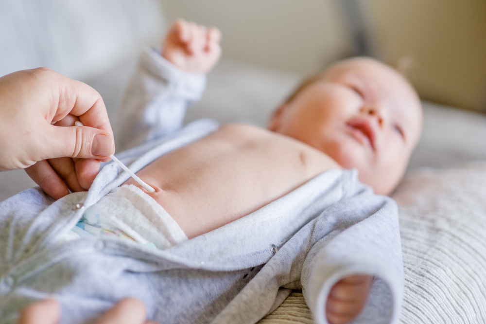 Hernia umbilical Bebé