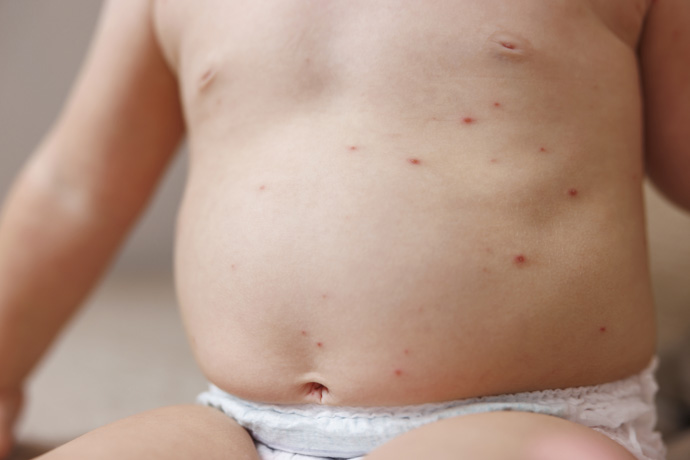 Bebé con petequias en el abdomen.