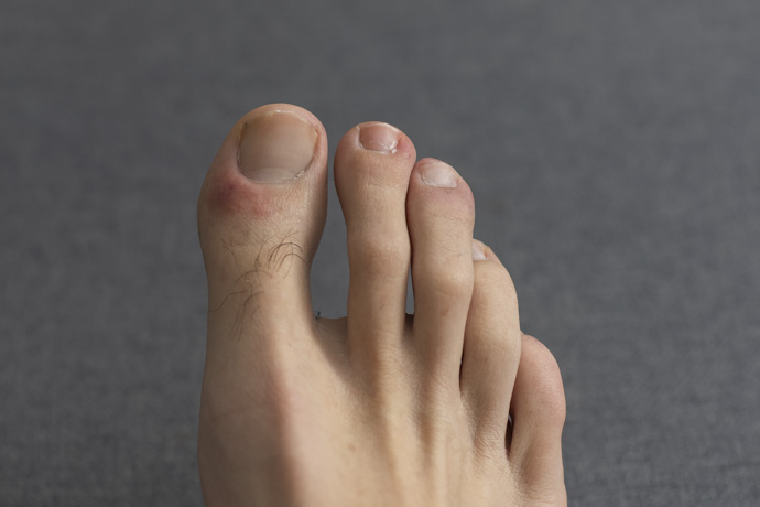 Hombre con manchas rojas en los pies por pie de atleta