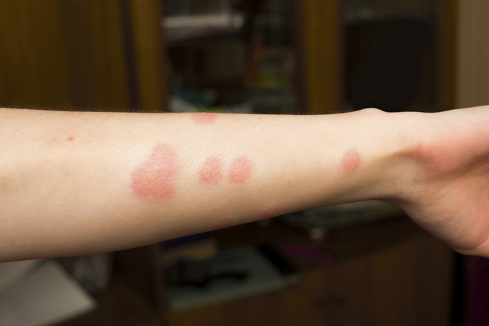 Ejemplo de picaduras de pulgas en el brazo.