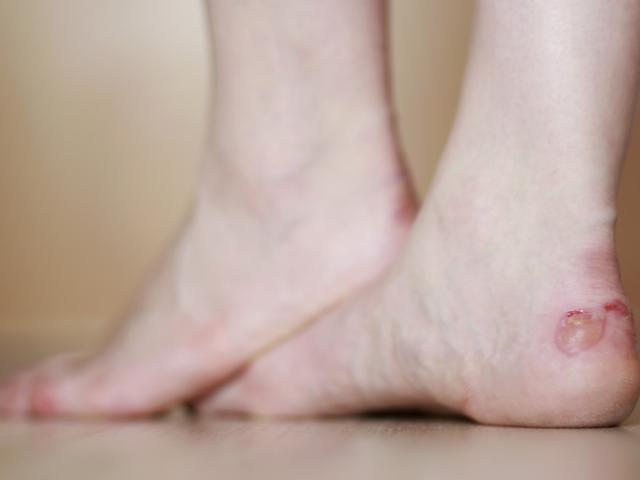 Persona con ampolla en los pies